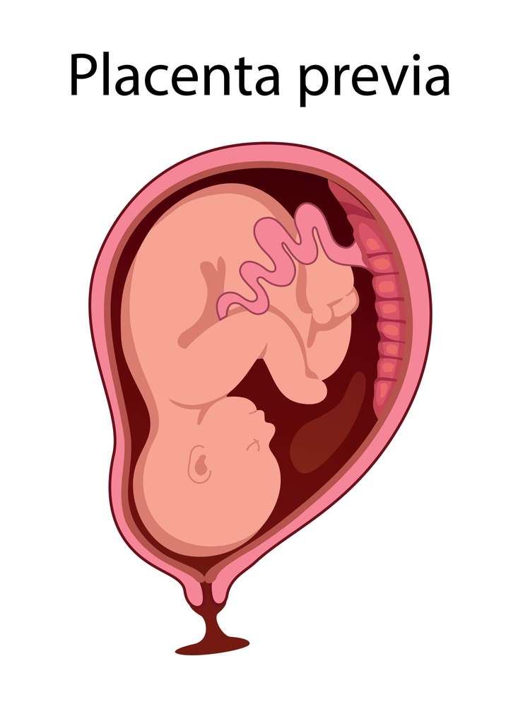 placenta previa