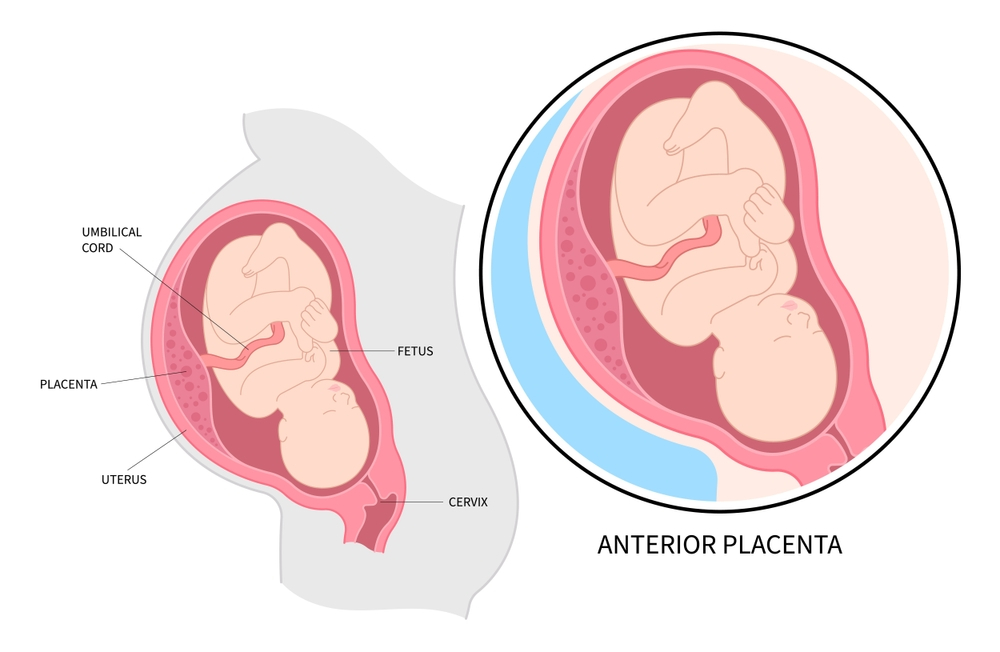 anterior placenta